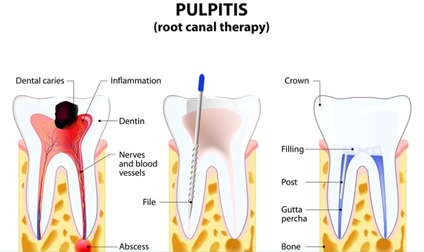Root Canal Dentist Astoria